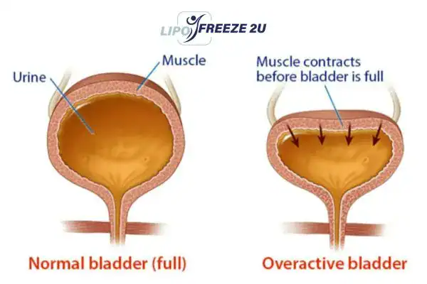 diagram of overactive bladder treatment Runcorn