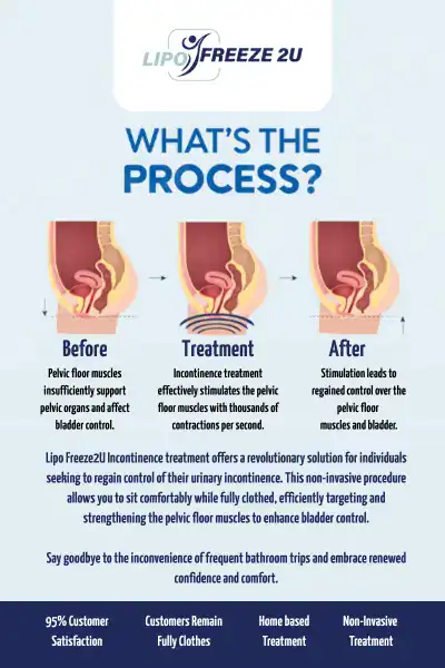 Diagram of how incontinence treatment Runcorn works.