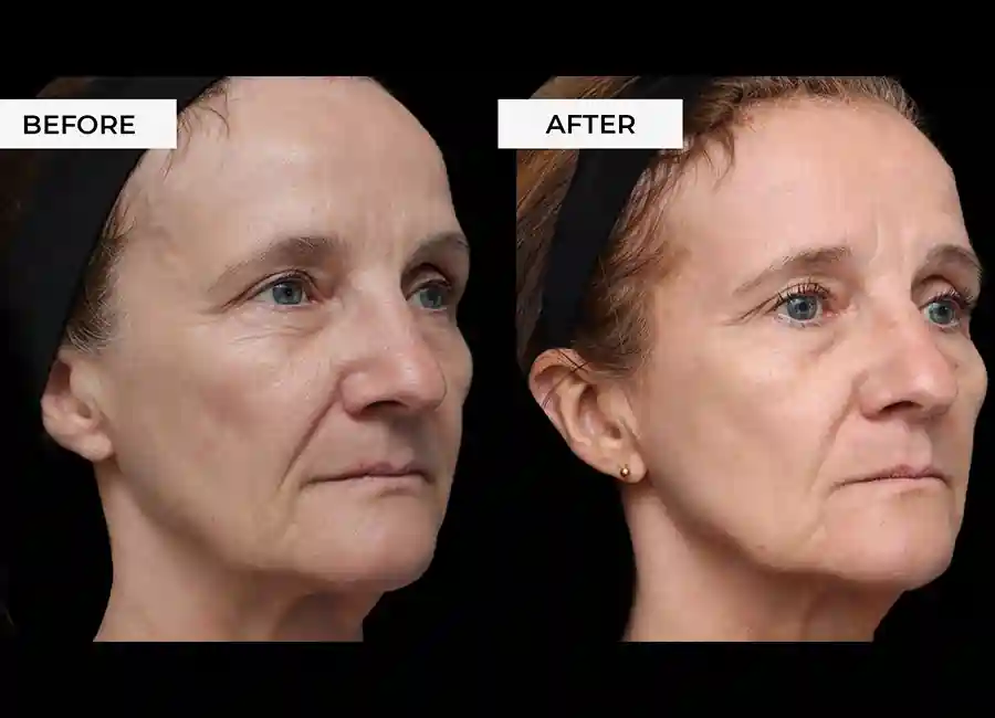 How Many RF Microneedling Sessions Will You Need to See a Difference Runcorn?